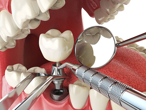 Best Emergency Dentist for Lost Fillings or Crowns in Marion, MT